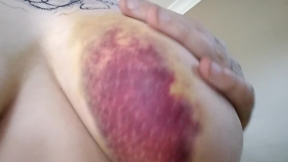 Extreme Bruising after Car Accident (2016)_Elle Hell PornHubPremium