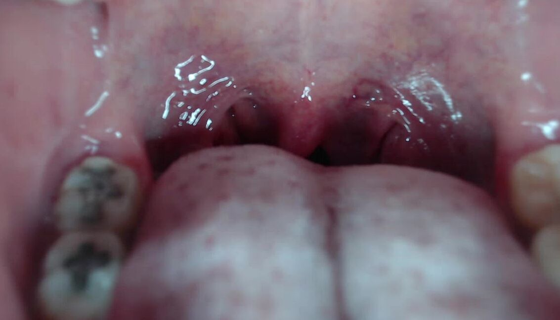 Braces,Close-Ups,Mouth Fetish,Teeth,Uvula Fetish miaisabella3 braces mouth uvula fetish ManyVids