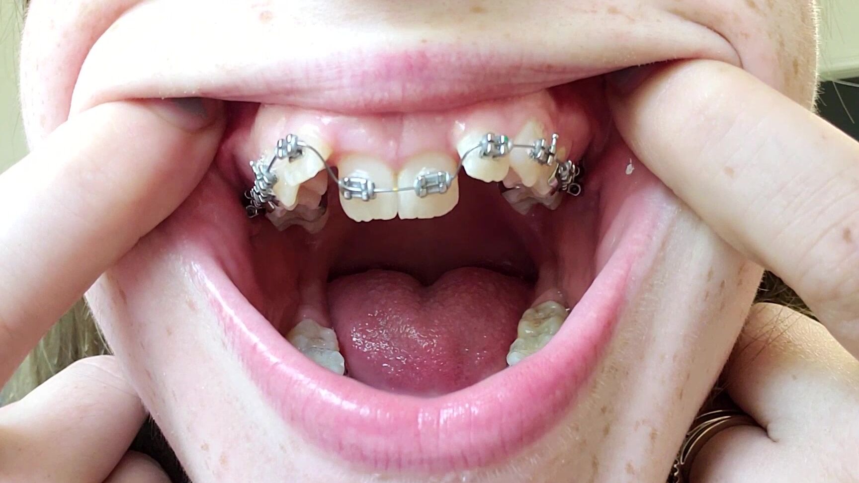 Braces, Mouth Fetish, Spit Fetish, Teeth, Tongue Fetish bigbuttbooty mouth spit and braces worship ManyVids