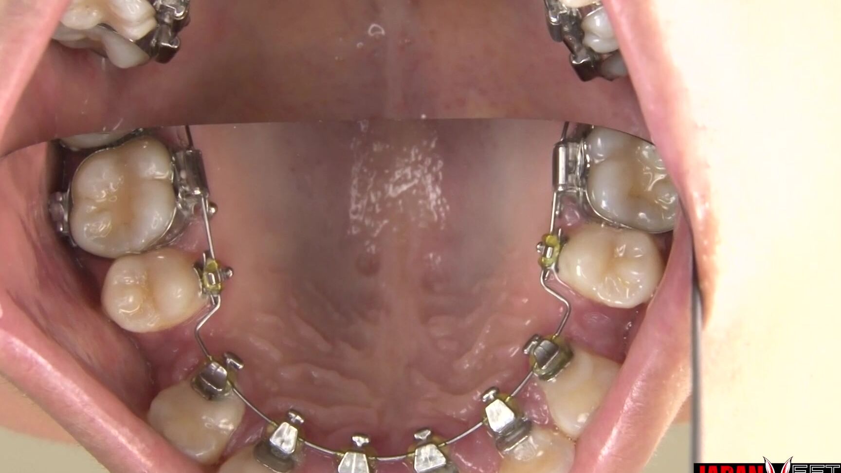 Japan Ff Ortho Obsession My Journey With Braces